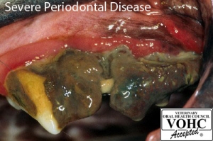 Severe Periodontal Disease